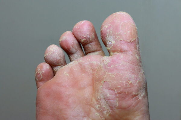 Photo of foot with athlete's foot, which is a common fungal infection for rugby players